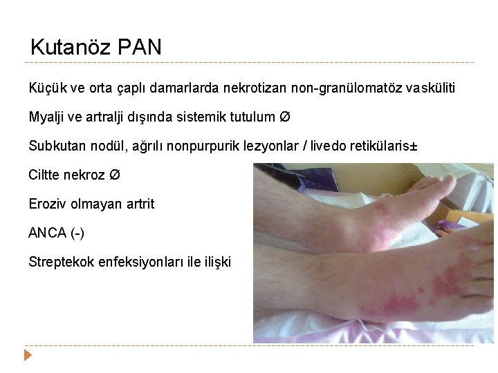 Kutanöz PAN Küçük ve orta çaplı damarlarda nekrotizan non-granülomatöz vasküliti Myalji ve artralji dışında Kutanöz PAN Küçük ve orta çaplı damarlarda nekrotizan non-granülomatöz vasküliti Myalji ve artralji dışında