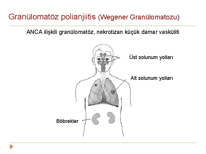 Granülomatöz polianjiitis (Wegener Granülomatozu) ANCA ilişkili granülomatöz, nekrotizan küçük damar vasküliti Üst solunum yolları Granülomatöz polianjiitis (Wegener Granülomatozu) ANCA ilişkili granülomatöz, nekrotizan küçük damar vasküliti Üst solunum yolları