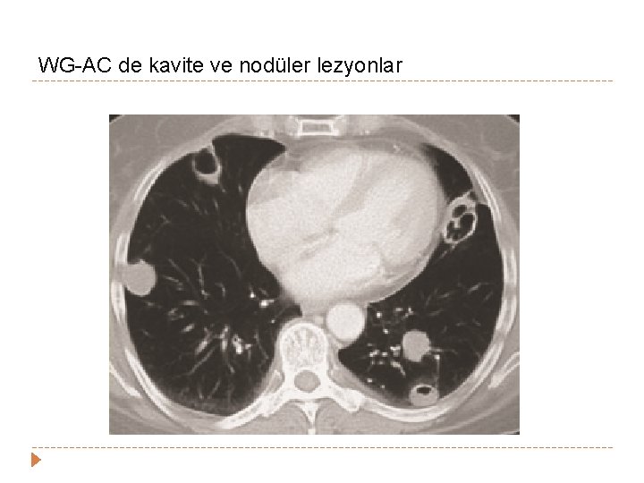 WG-AC de kavite ve nodüler lezyonlar WG-AC de kavite ve nodüler lezyonlar