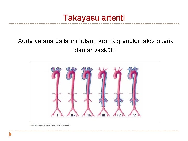 Takayasu arteriti Aorta ve ana dallarını tutan, kronik granülomatöz büyük damar vasküliti Takayasu arteriti Aorta ve ana dallarını tutan, kronik granülomatöz büyük damar vasküliti