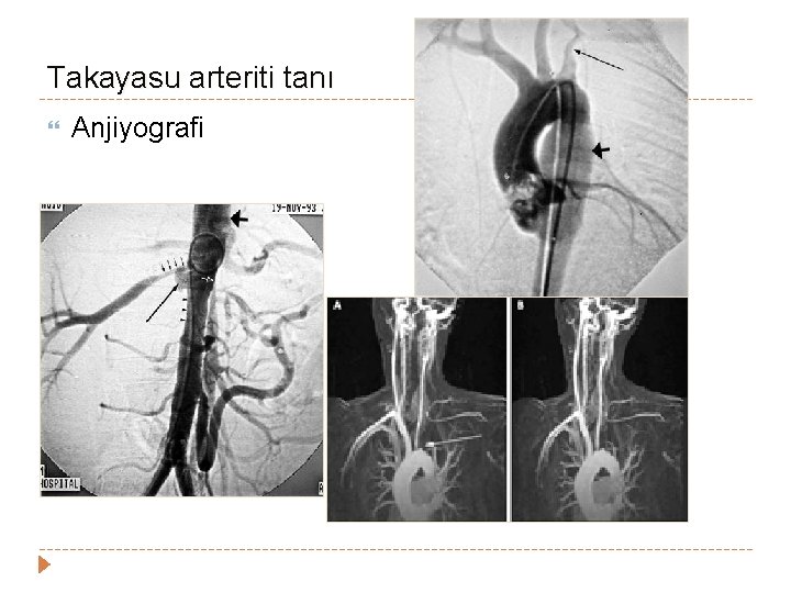 Takayasu arteriti tanı Anjiyografi Takayasu arteriti tanı Anjiyografi