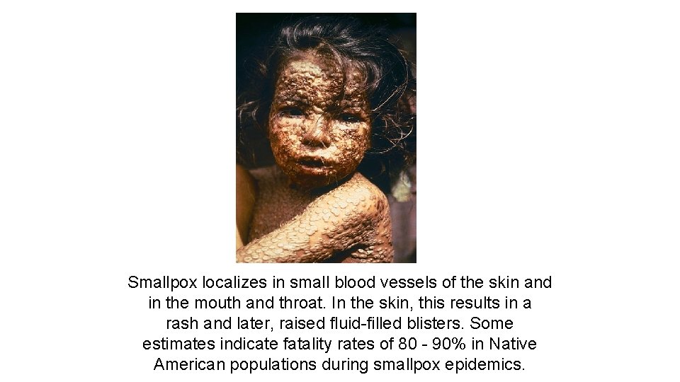 Smallpox localizes in small blood vessels of the skin and in the mouth and