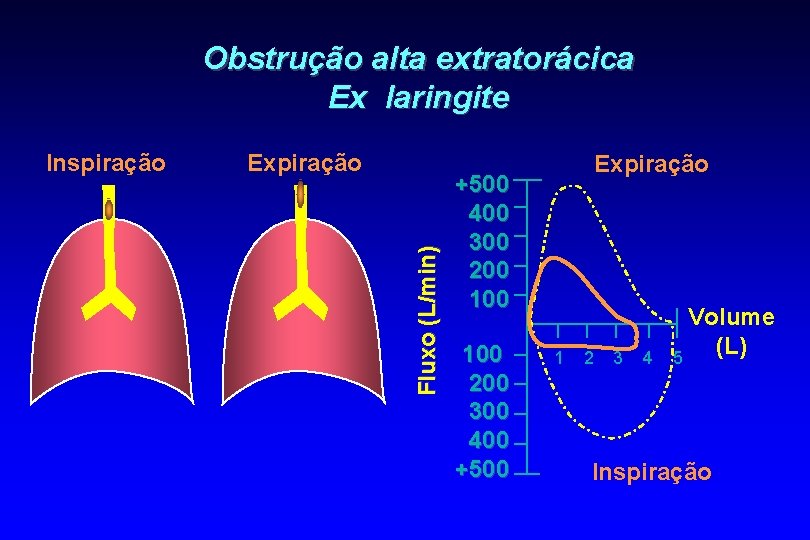 Obstrução alta extratorácica Ex laringite Expiração Fluxo (L/min) Inspiração Expiração +500 400 300 200