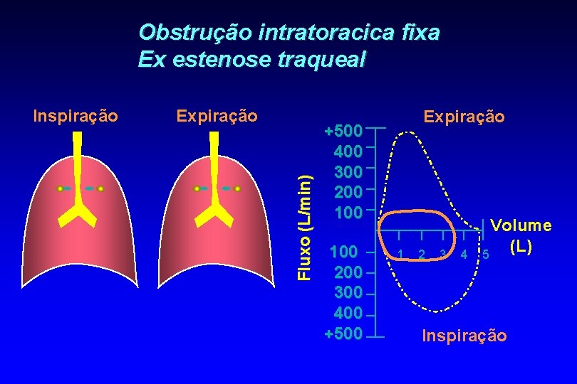 Obstrução intratoracica fixa Ex estenose traqueal Expiração Fluxo (L/min) Inspiração Expiração +500 400 300