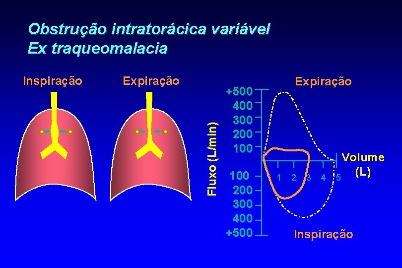 Obstrução intratorácica variável Ex traqueomalacia Expiração Fluxo (L/min) Inspiração Expiração +500 400 300 200