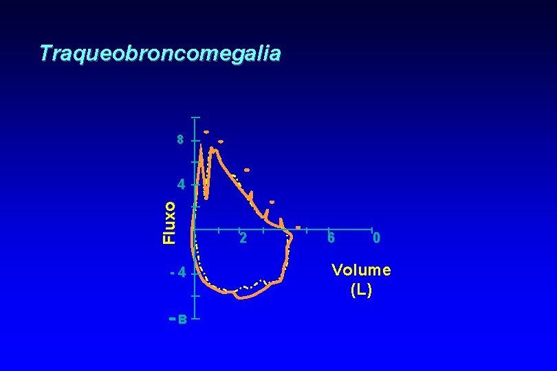 Traqueobroncomegalia 8 Fluxo 4 -4 -B 2 6 0 Volume (L) 