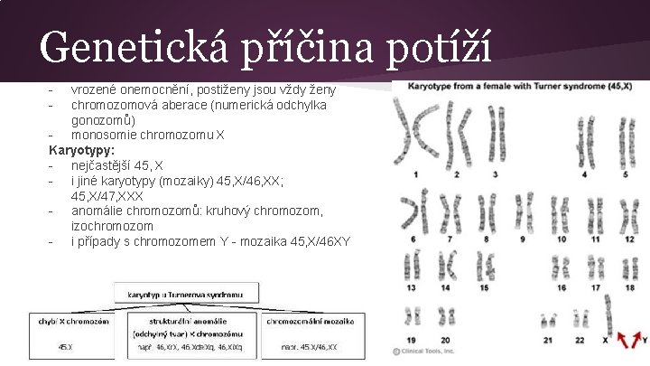 Genetická příčina potíží - vrozené onemocnění, postiženy jsou vždy ženy chromozomová aberace (numerická odchylka