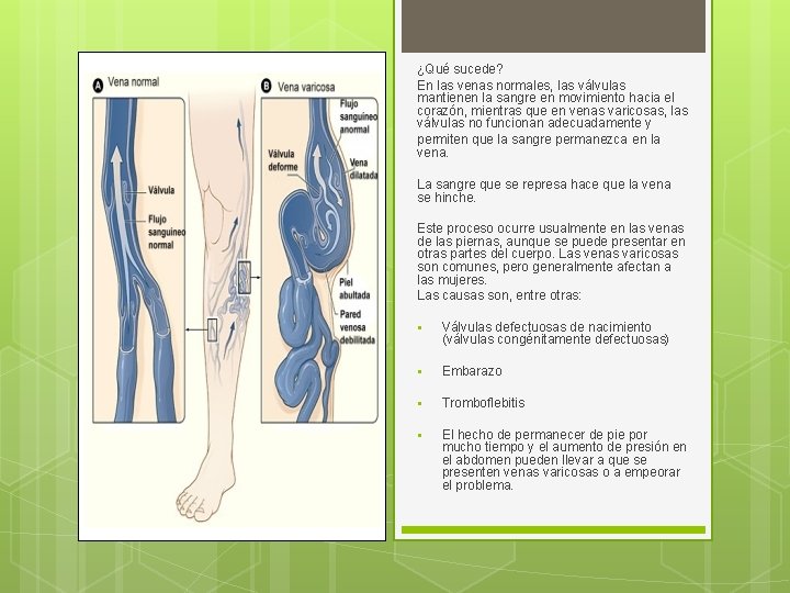 ¿Qué sucede? En las venas normales, las válvulas mantienen la sangre en movimiento hacia