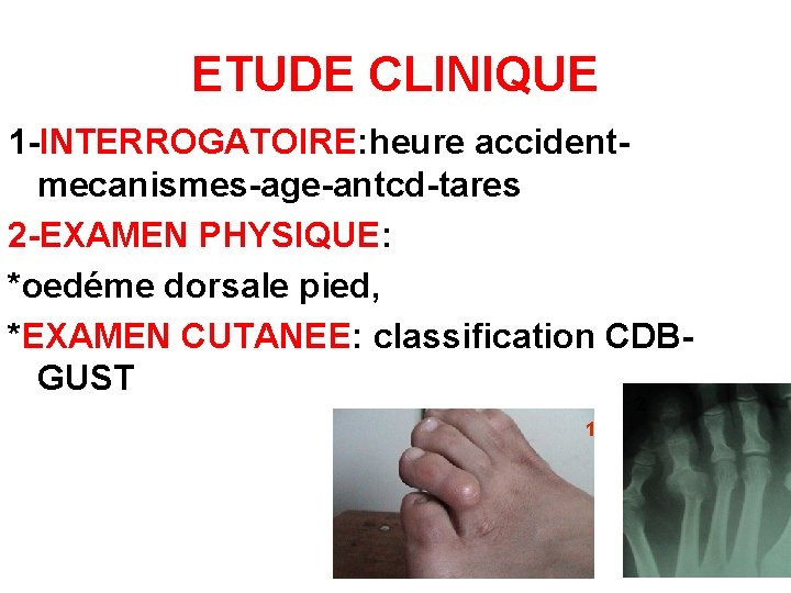 ETUDE CLINIQUE 1 -INTERROGATOIRE: heure accidentmecanismes-age-antcd-tares 2 -EXAMEN PHYSIQUE: *oedéme dorsale pied, *EXAMEN CUTANEE: