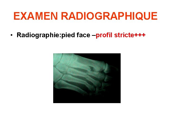 EXAMEN RADIOGRAPHIQUE • Radiographie: pied face –profil stricte+++ 