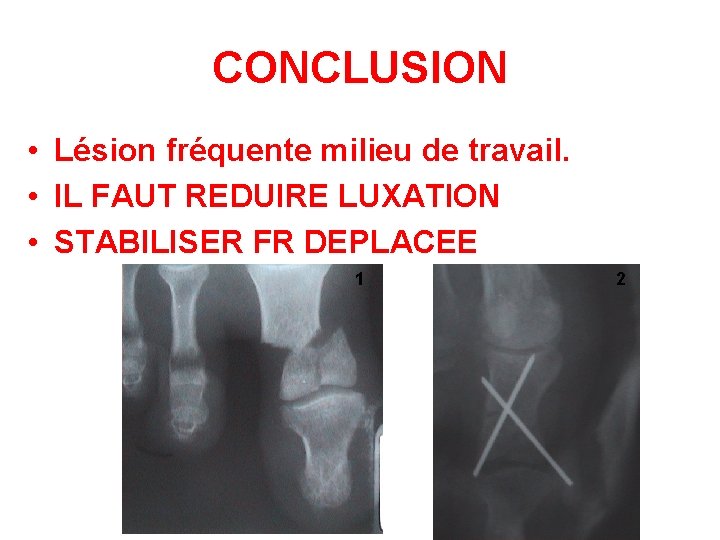 CONCLUSION • Lésion fréquente milieu de travail. • IL FAUT REDUIRE LUXATION • STABILISER