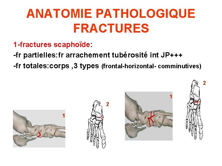 ANATOMIE PATHOLOGIQUE FRACTURES 1 -fractures scaphoïde: -fr partielles: fr arrachement tubérosité int JP+++ -fr