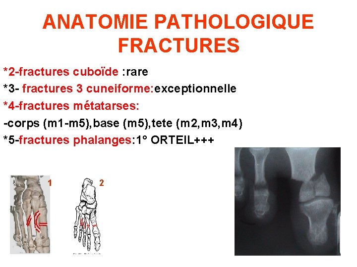 ANATOMIE PATHOLOGIQUE FRACTURES *2 -fractures cuboïde : rare *3 - fractures 3 cuneiforme: exceptionnelle