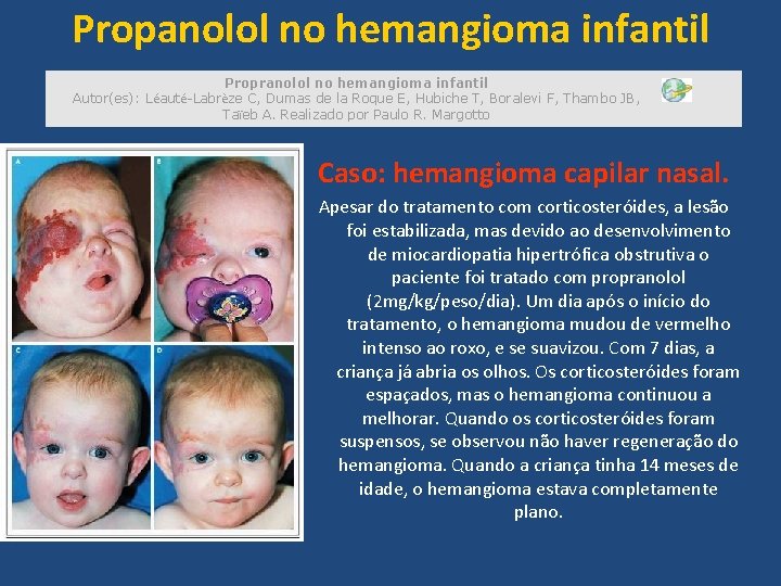 Propanolol no hemangioma infantil Propranolol no hemangioma infantil Autor(es): Léauté-Labrèze C, Dumas de la