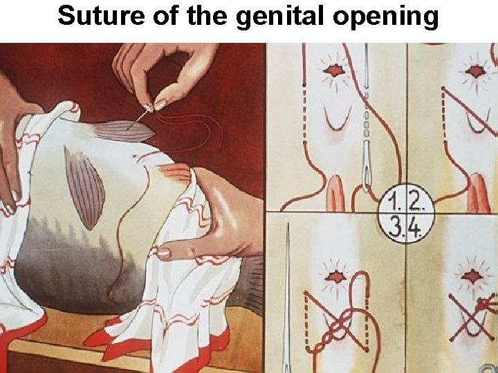 Suture of the genital opening 