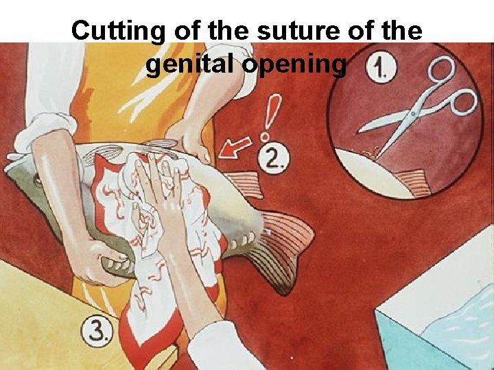 Cutting of the suture of the genital opening 