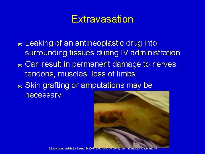Extravasation Leaking of an antineoplastic drug into surrounding tissues during IV administration Can result