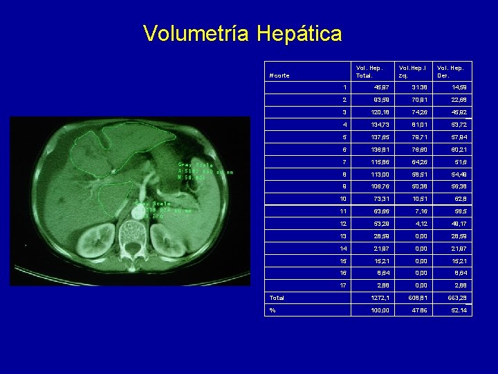 Volumetría Hepática Vol. Hep. Total. # corte Vol. Hep. I zq. Vol. Hep. Der.