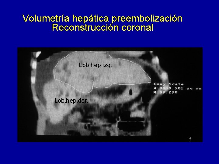 Volumetría hepática preembolización Reconstrucción coronal Lob. hep. izq. Lob. hep. der. 