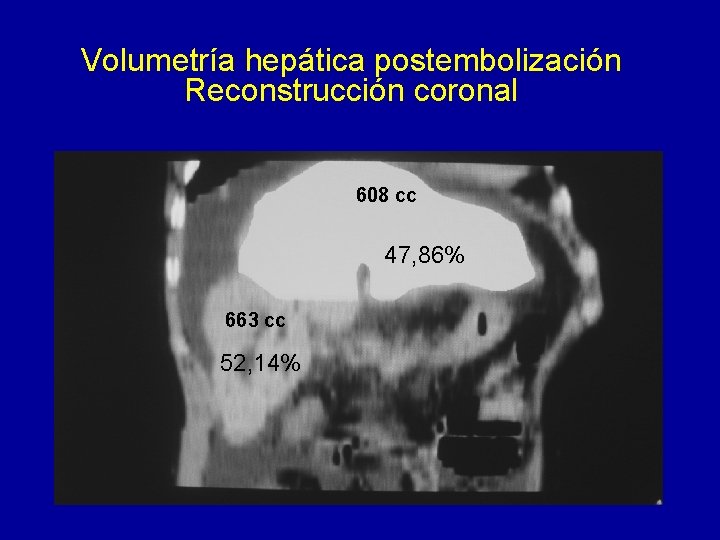 Volumetría hepática postembolización Reconstrucción coronal 608 cc 47, 86% 663 cc 52, 14% 