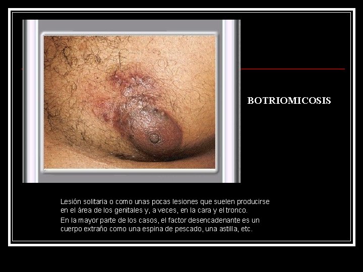 BOTRIOMICOSIS Lesión solitaria o como unas pocas lesiones que suelen producirse en el área