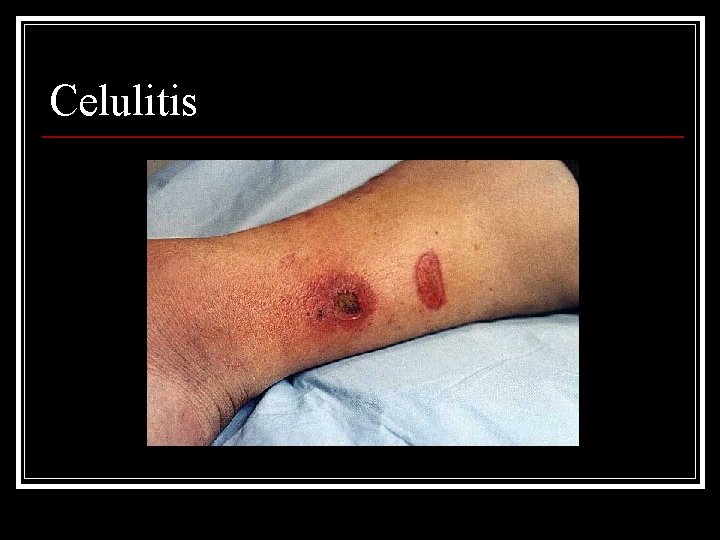 Celulitis 