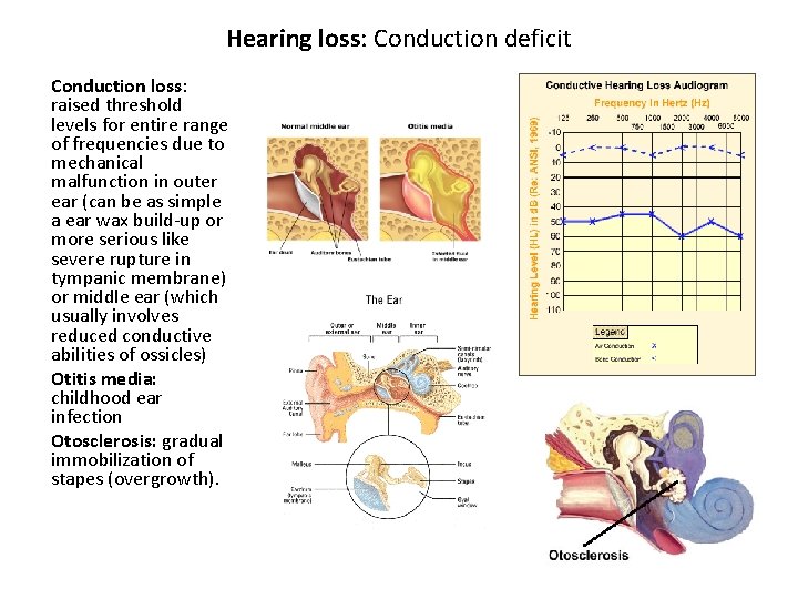 Hearing loss: Conduction deficit Conduction loss: raised threshold levels for entire range of frequencies