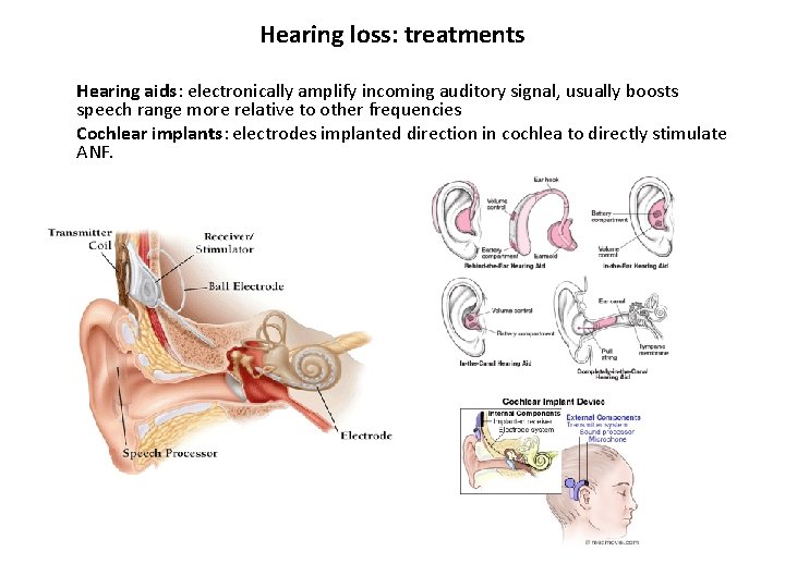 Hearing loss: treatments Hearing aids: electronically amplify incoming auditory signal, usually boosts speech range