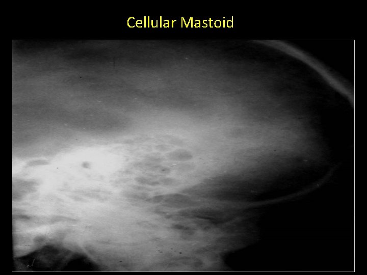 Cellular Mastoid 