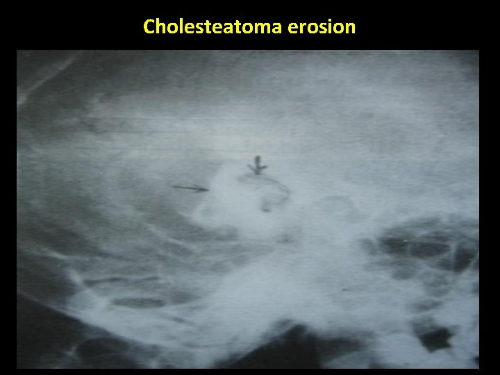 Cholesteatoma erosion 