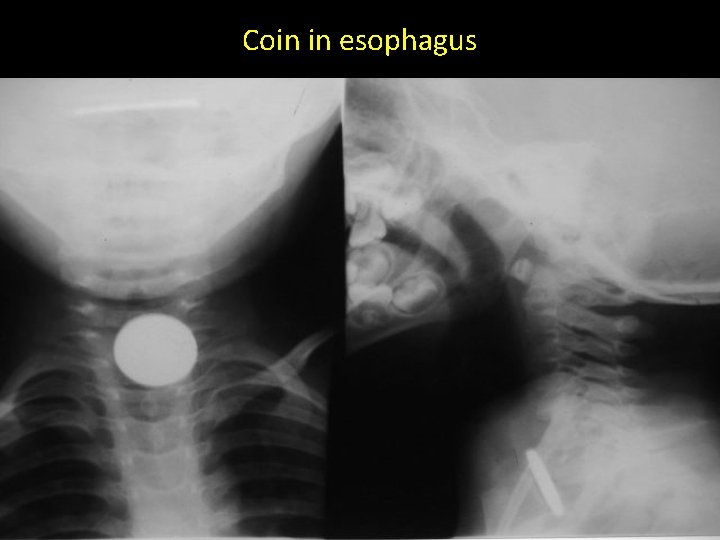 Coin in esophagus 