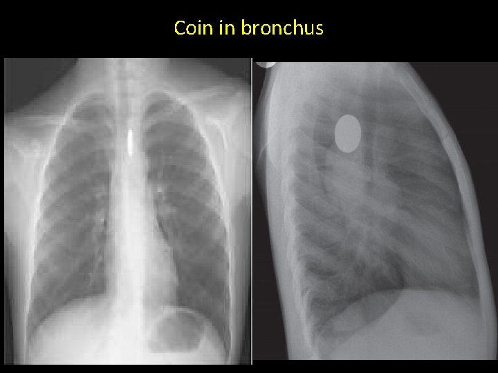 Coin in bronchus 