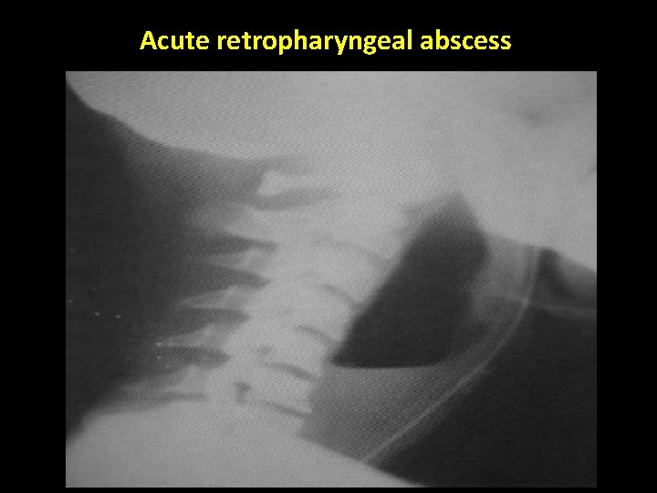 Acute retropharyngeal abscess 