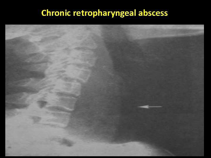 Chronic retropharyngeal abscess 