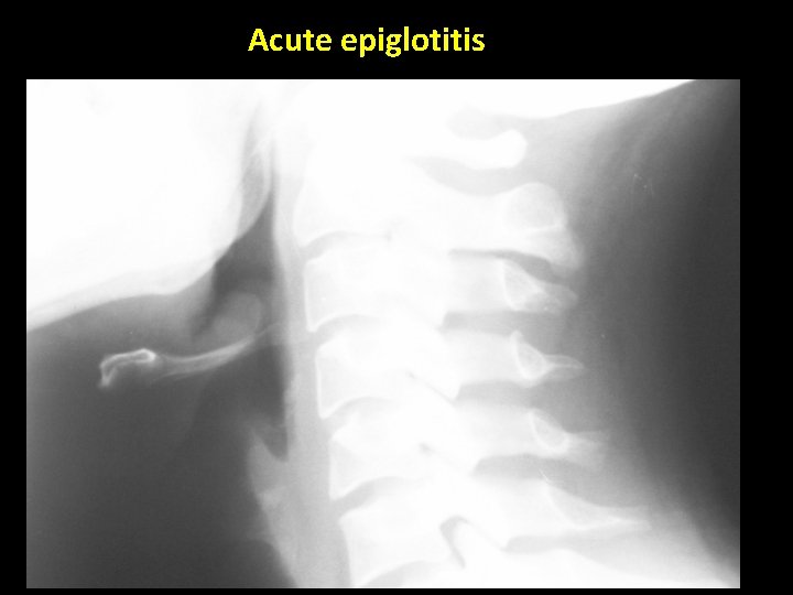Acute epiglotitis 