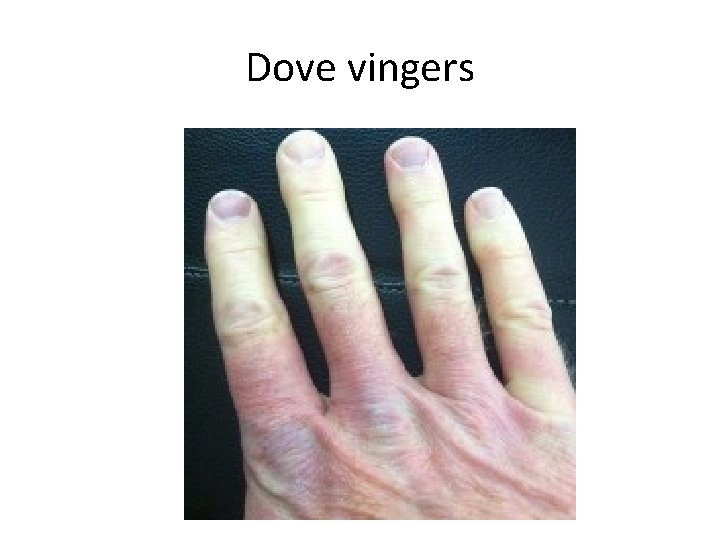 Dove vingers 