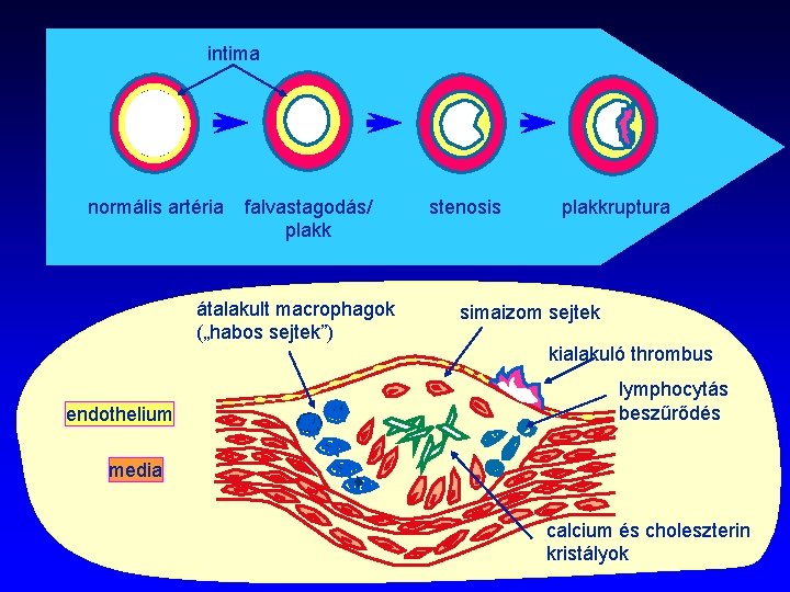 intima normális artéria falvastagodás/ plakk átalakult macrophagok („habos sejtek”) endothelium stenosis plakkruptura simaizom sejtek