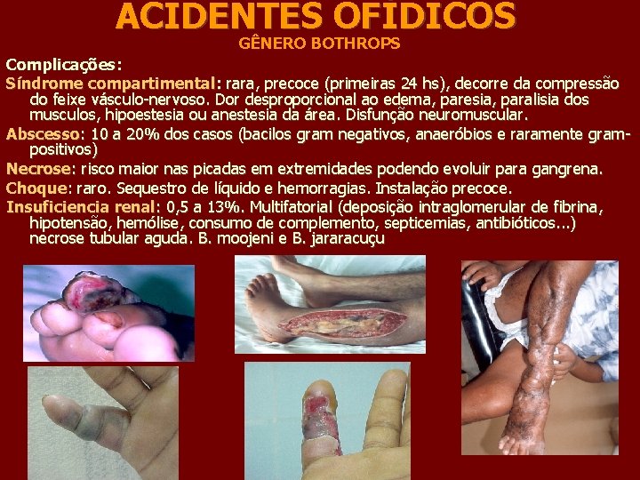 ACIDENTES OFÍDICOS GÊNERO BOTHROPS Complicações: Síndrome compartimental: rara, precoce (primeiras 24 hs), decorre da