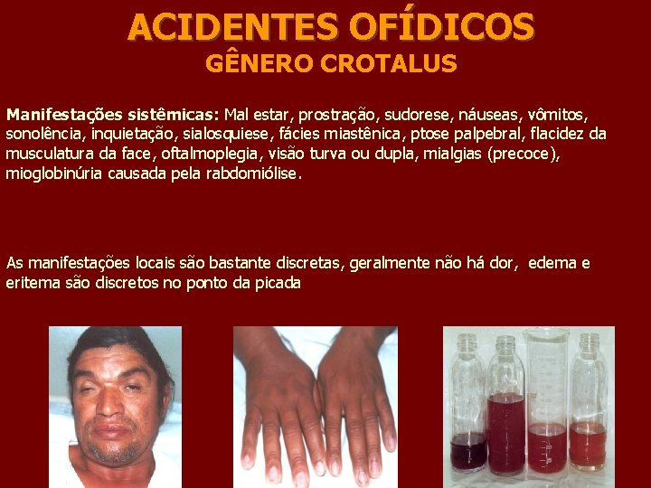 ACIDENTES OFÍDICOS GÊNERO CROTALUS Manifestações sistêmicas: Mal estar, prostração, sudorese, náuseas, vômitos, sonolência, inquietação,