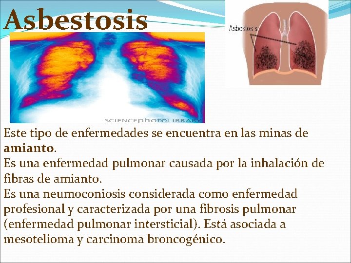 Asbestosis Este tipo de enfermedades se encuentra en las minas de amianto. Es una