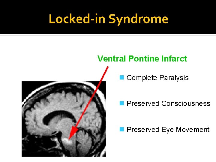 Locked-in Syndrome Ventral Pontine Infarct n Complete Paralysis n Preserved Consciousness n Preserved Eye