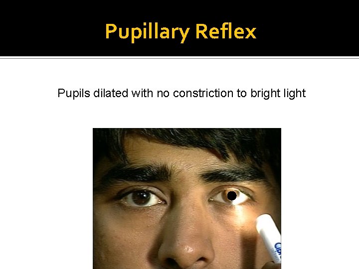 Pupillary Reflex Pupils dilated with no constriction to bright light 