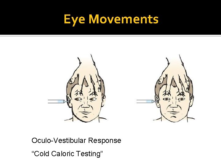 Eye Movements Oculo-Vestibular Response “Cold Caloric Testing” 