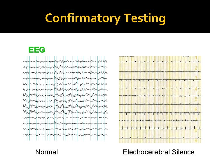 Confirmatory Testing EEG Normal Electrocerebral Silence 