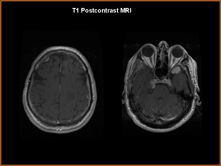 T 1 Postcontrast MRI 