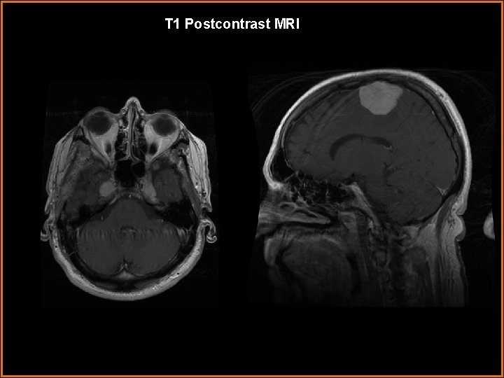 T 1 Postcontrast MRI 