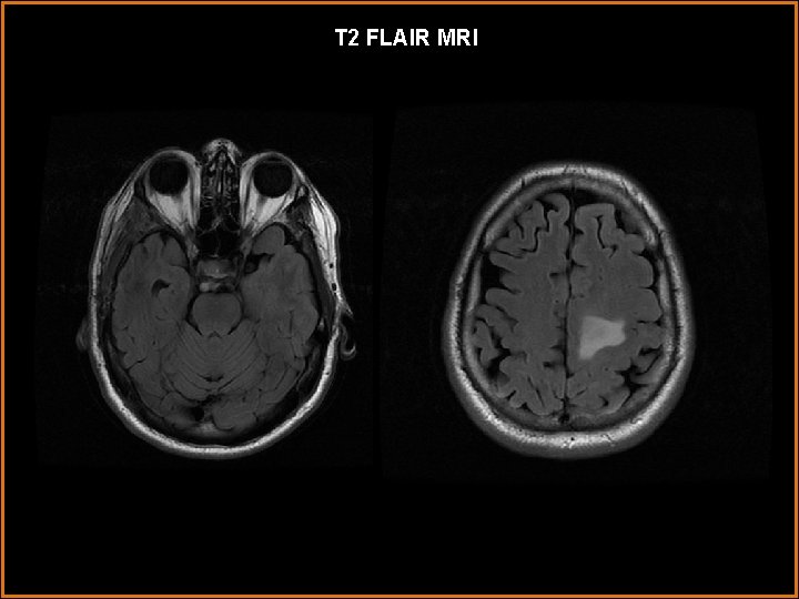 T 2 FLAIR MRI 