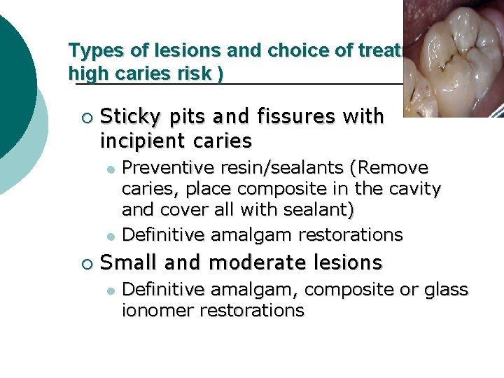 Types of lesions and choice of treatment ( high caries risk ) ¡ Sticky