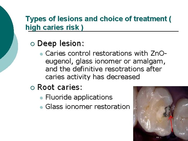 Types of lesions and choice of treatment ( high caries risk ) ¡ Deep