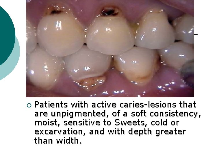 ¡ Patients with active caries-lesions that are unpigmented, of a soft consistency, moist, sensitive